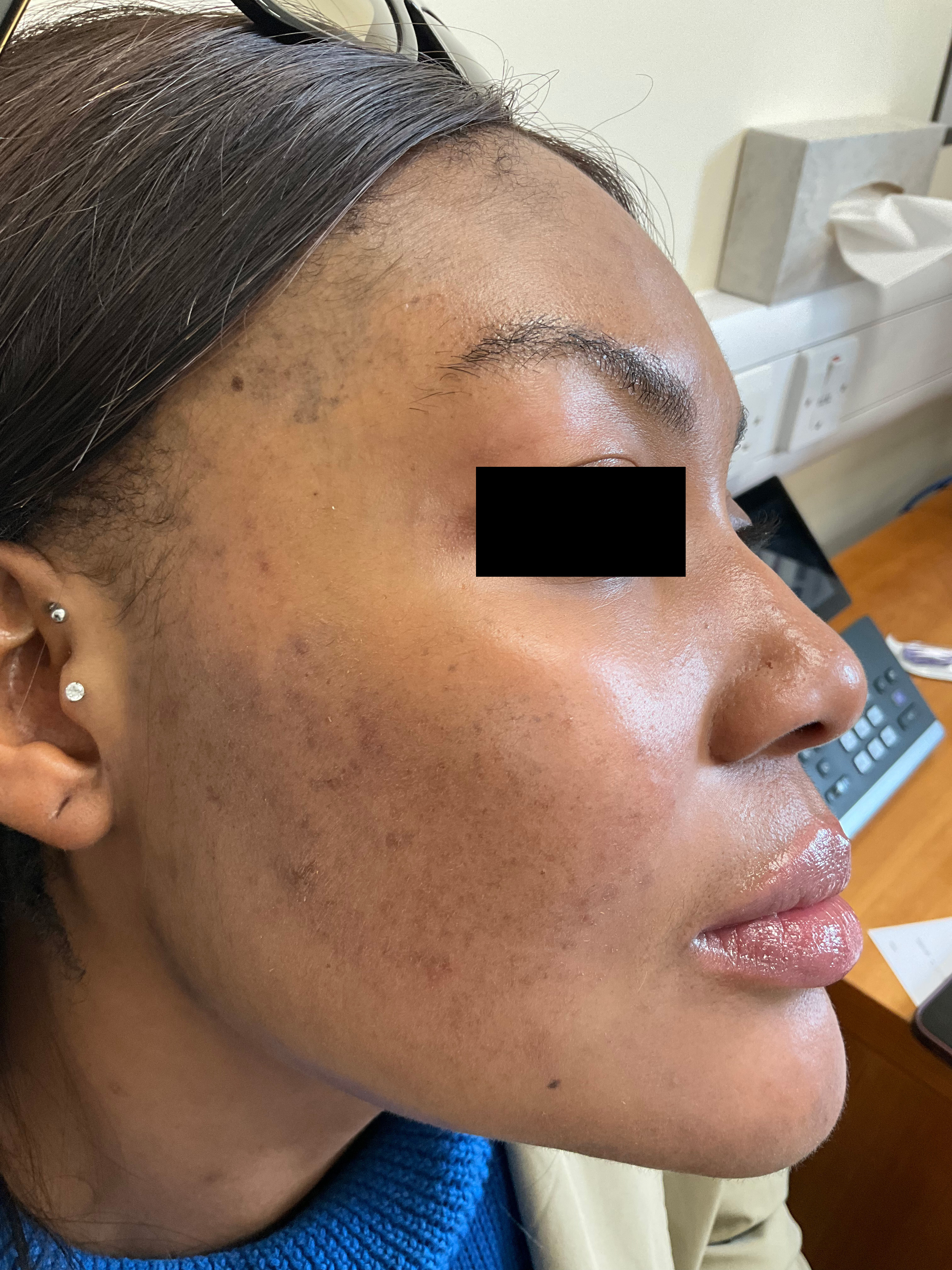 Close-up revealing brighter tone and fewer lesions after maintenance plan.