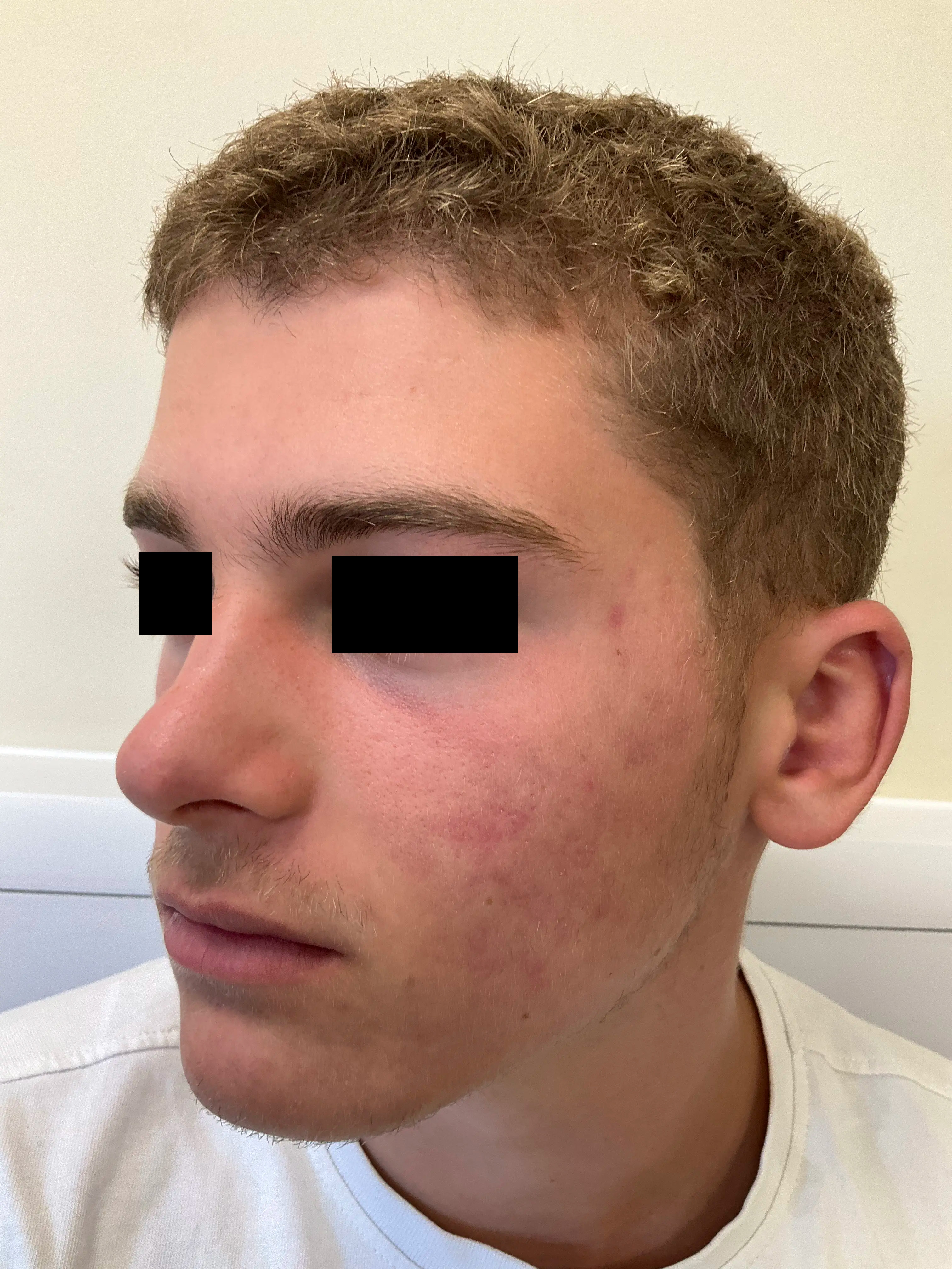 Jawline displaying calmer skin and softened scarring after protocol.