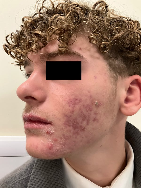 Jawline with active lesions and textural scarring prior to treatment.