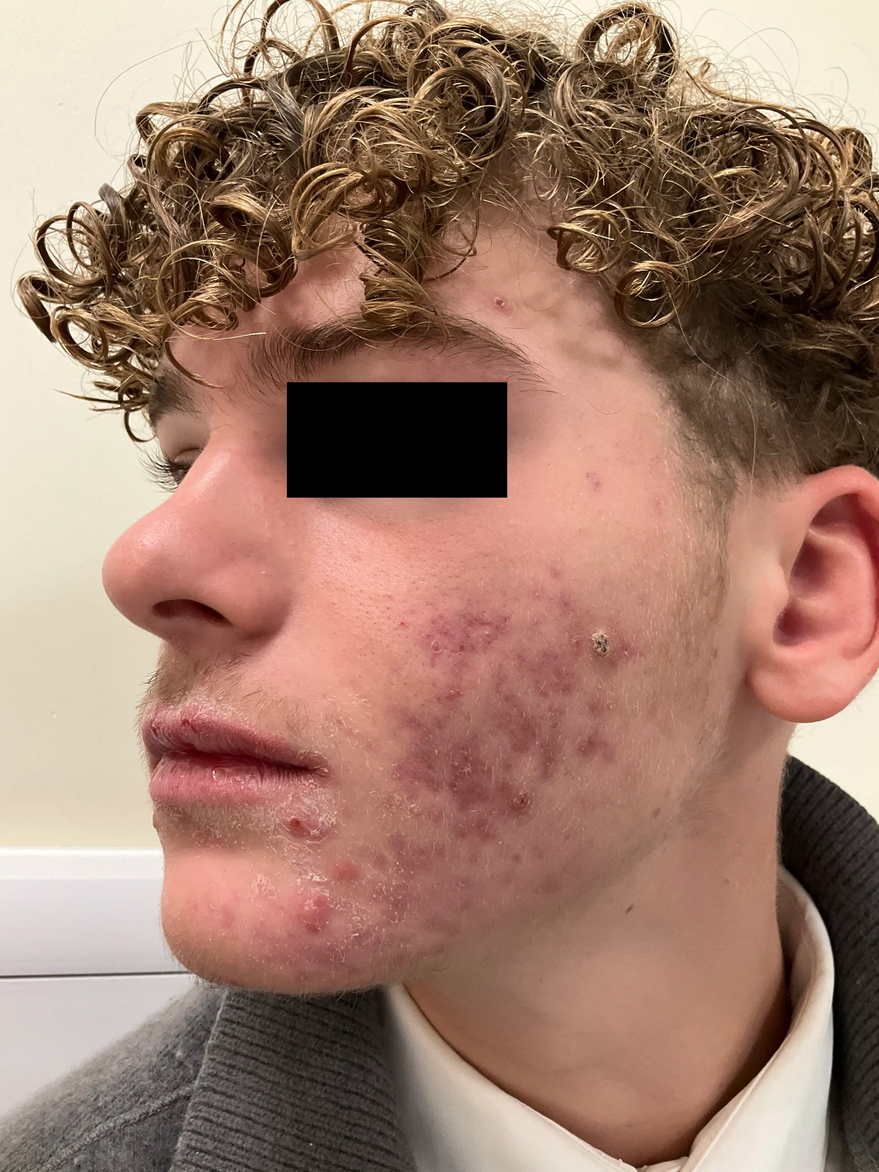 Jawline with active lesions and textural scarring prior to treatment.