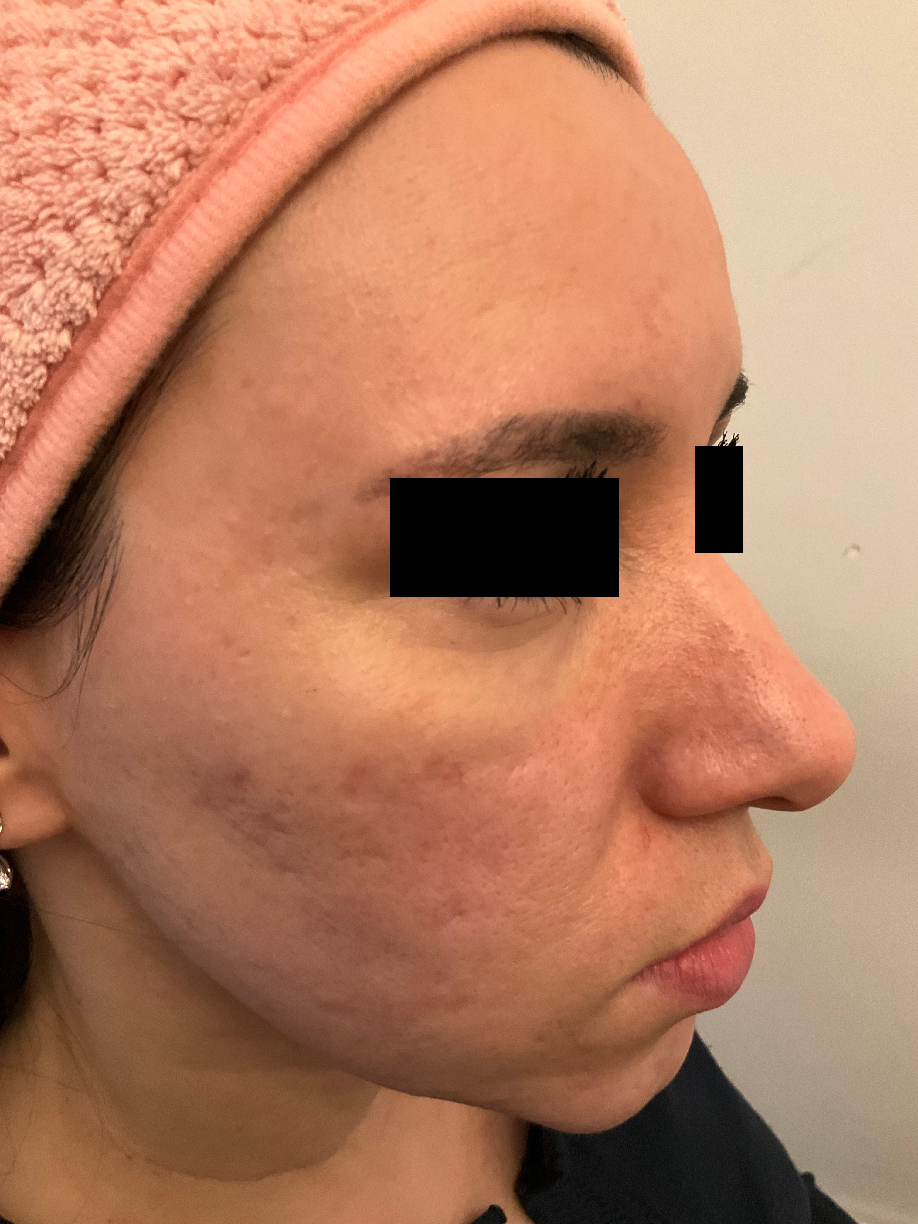 Cheek close-up with rolling scars and discoloration pre-remodeling.