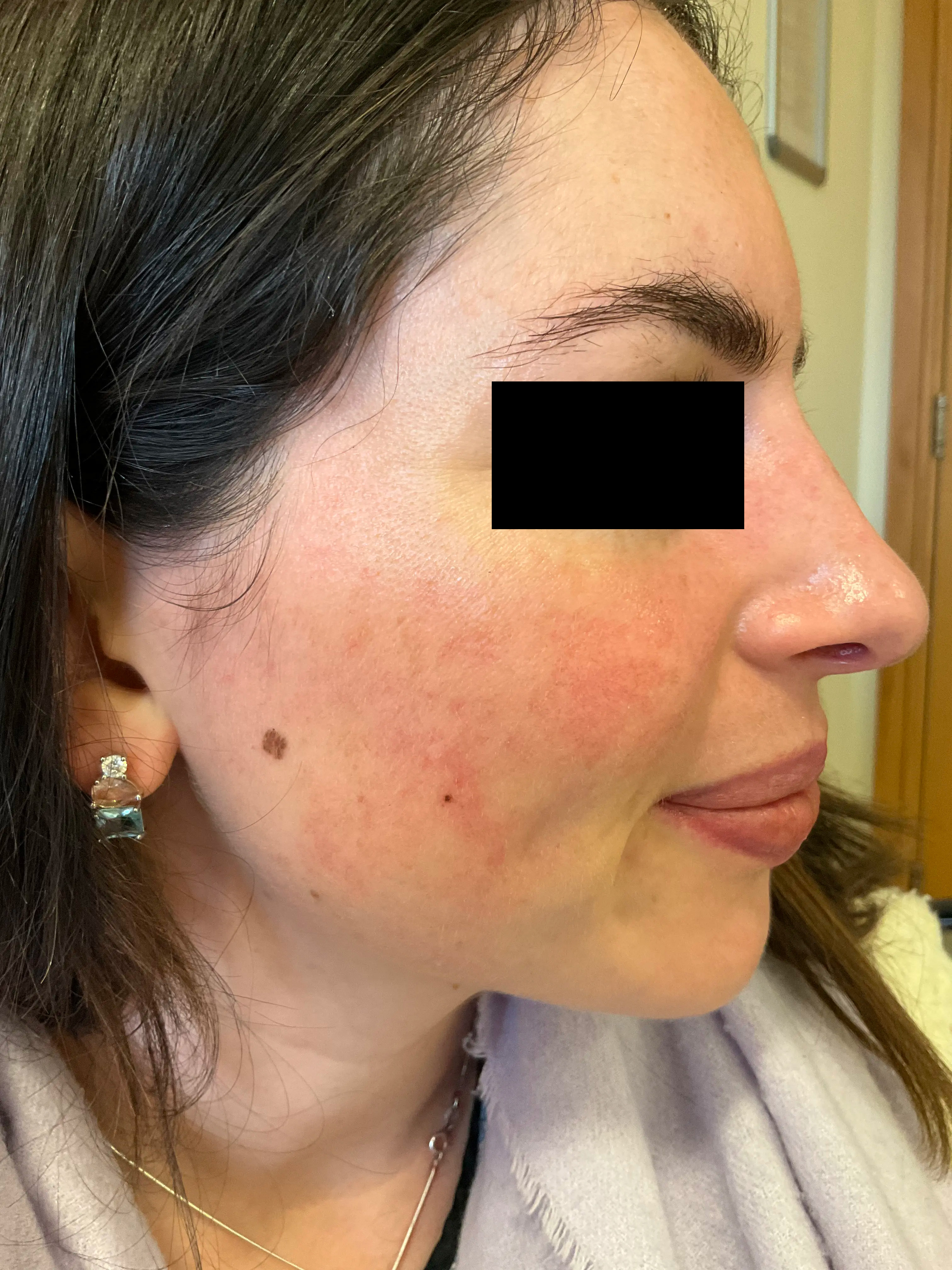 Cheek with visibly reduced inflammation and smoother tone after therapy.