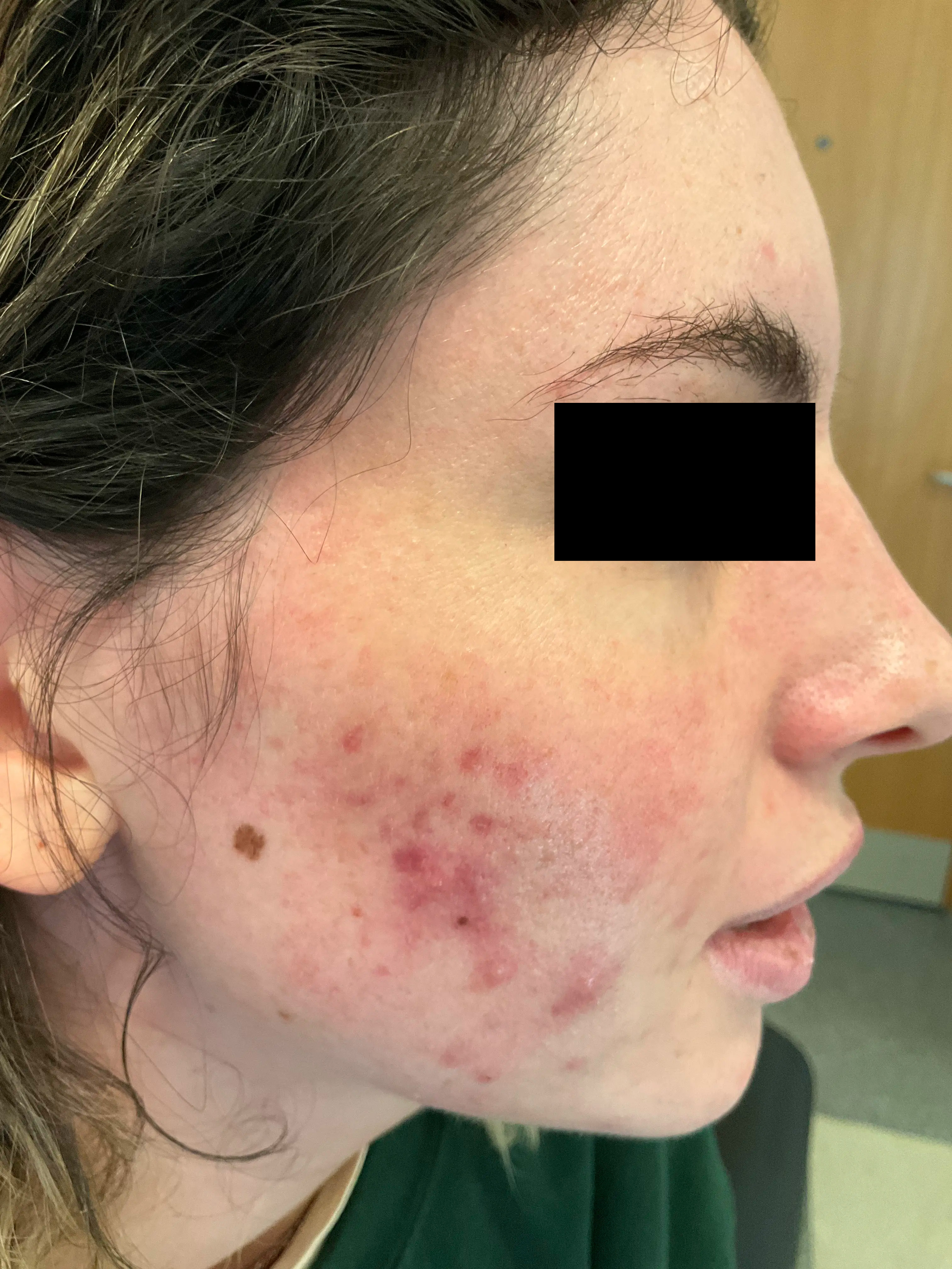 Cheek with inflamed papules and pustules before the acne protocol.