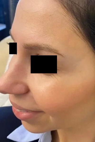 Forehead showing smoother texture and relaxed lines after treatment.