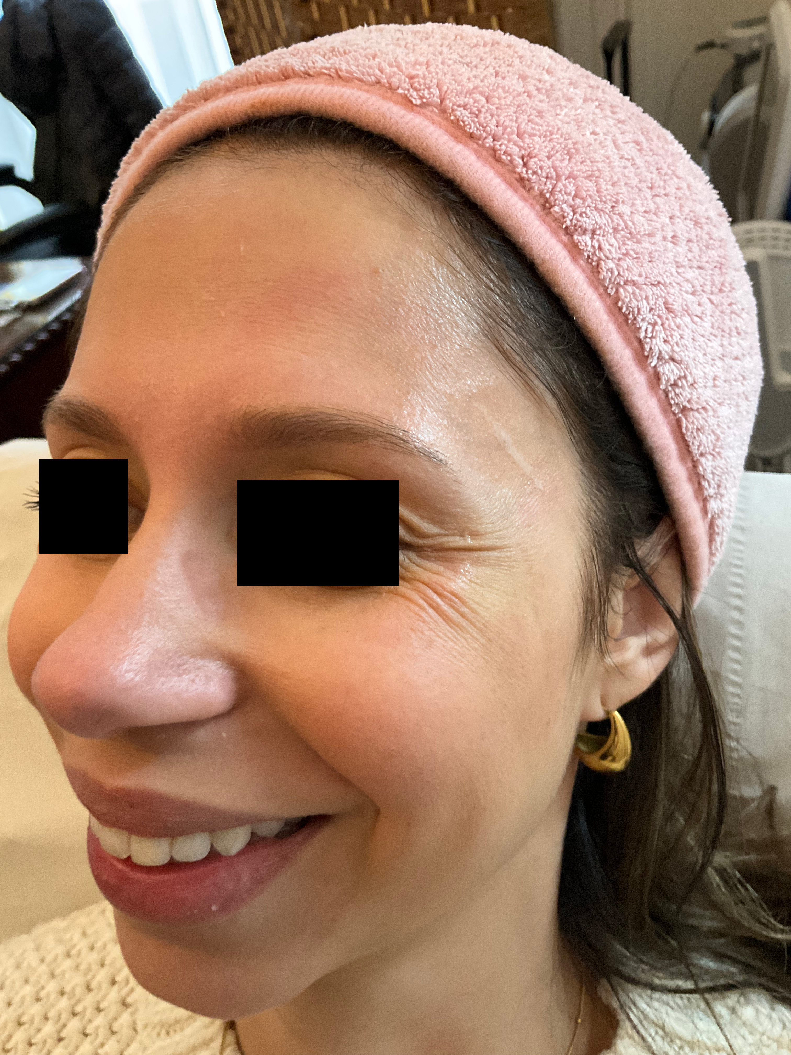 Forehead with pronounced expression lines before precise botox dosing.