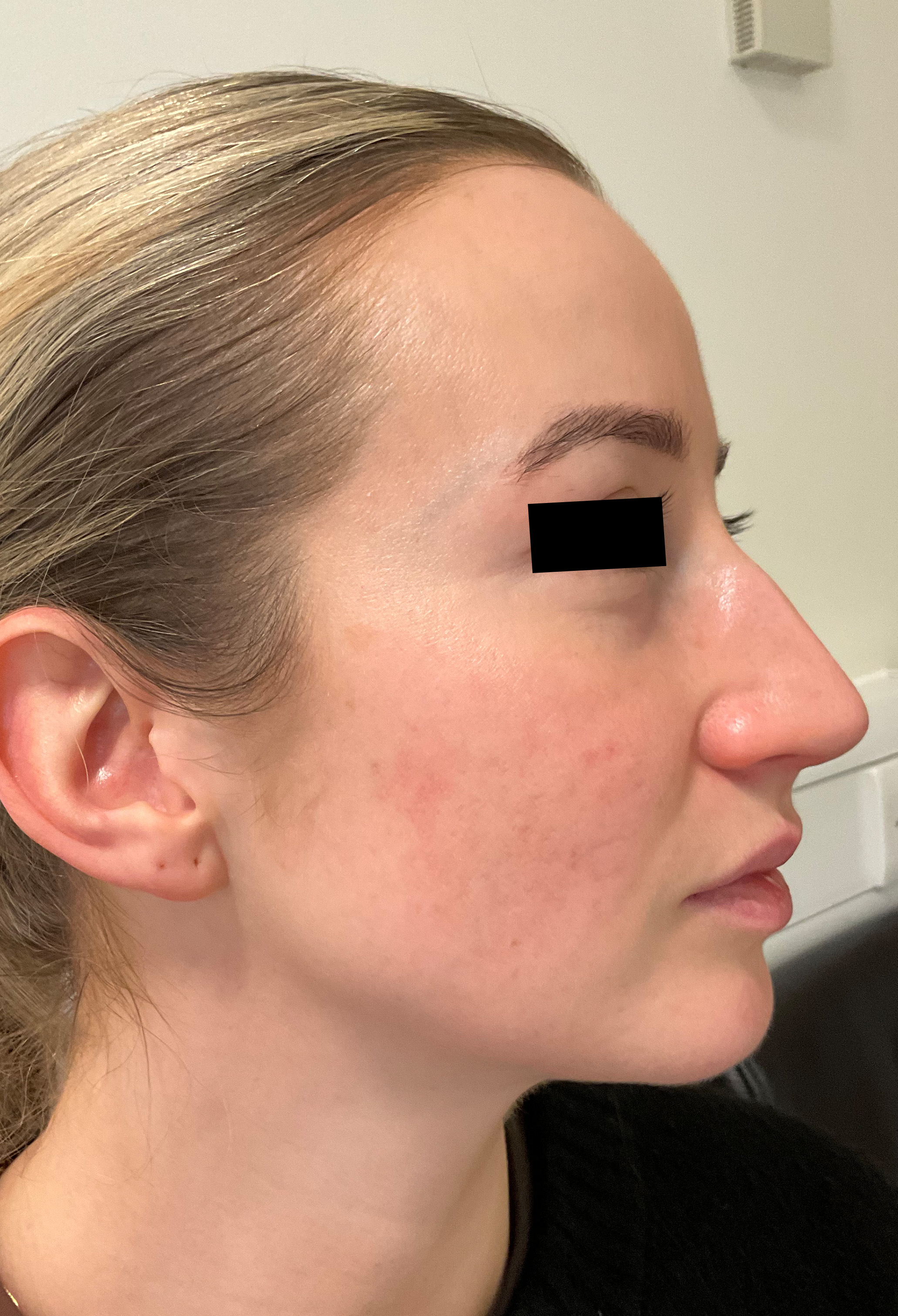 Skin appearing clearer with reduced lesions and improved texture after combined acne care.