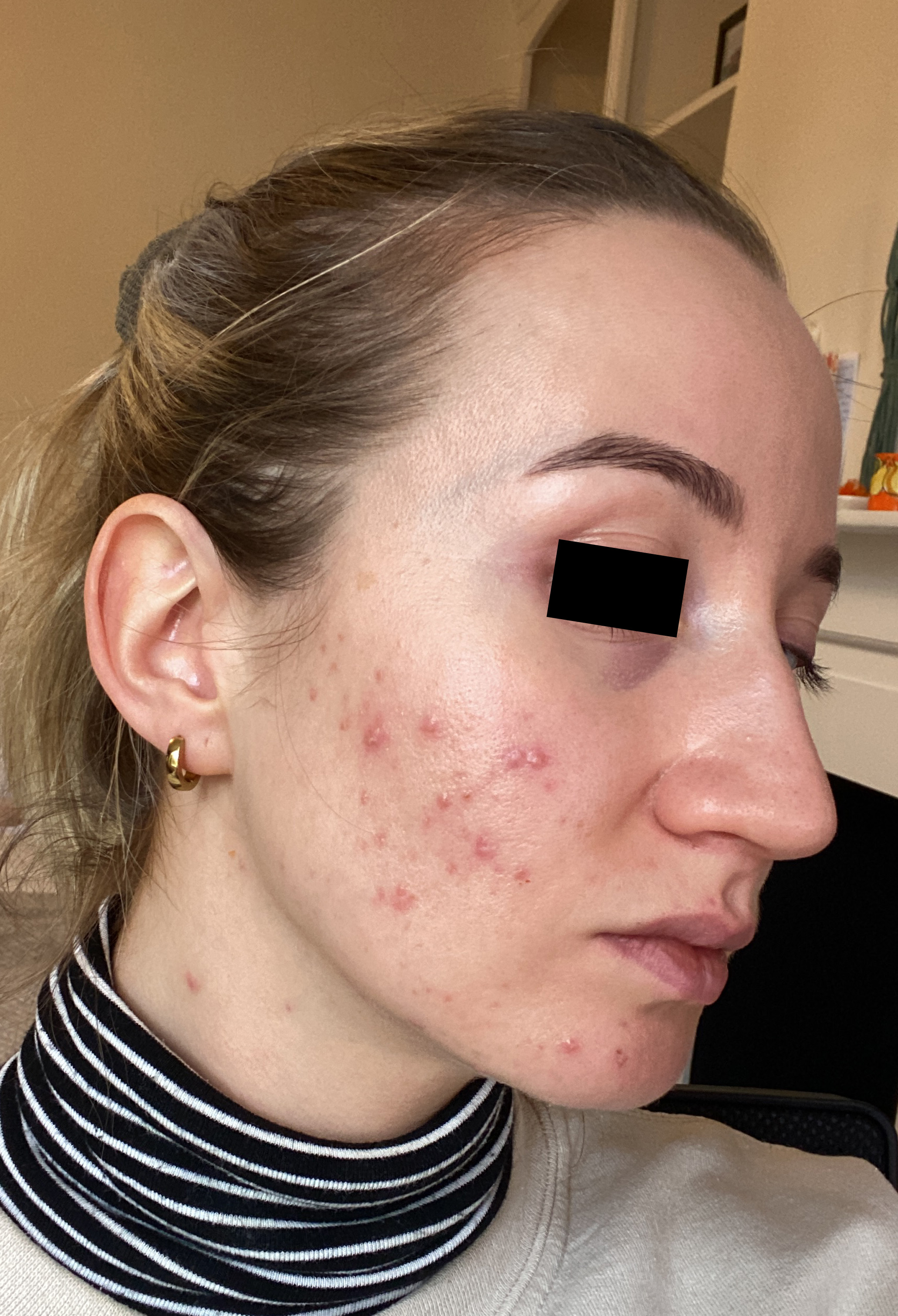 Skin with moderate inflammatory acne and comedones before combined treatment protocol.