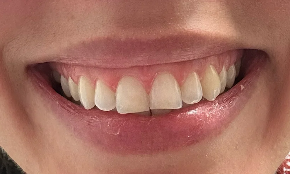 Full smile with balanced tooth-to-gum ratio after botox.
