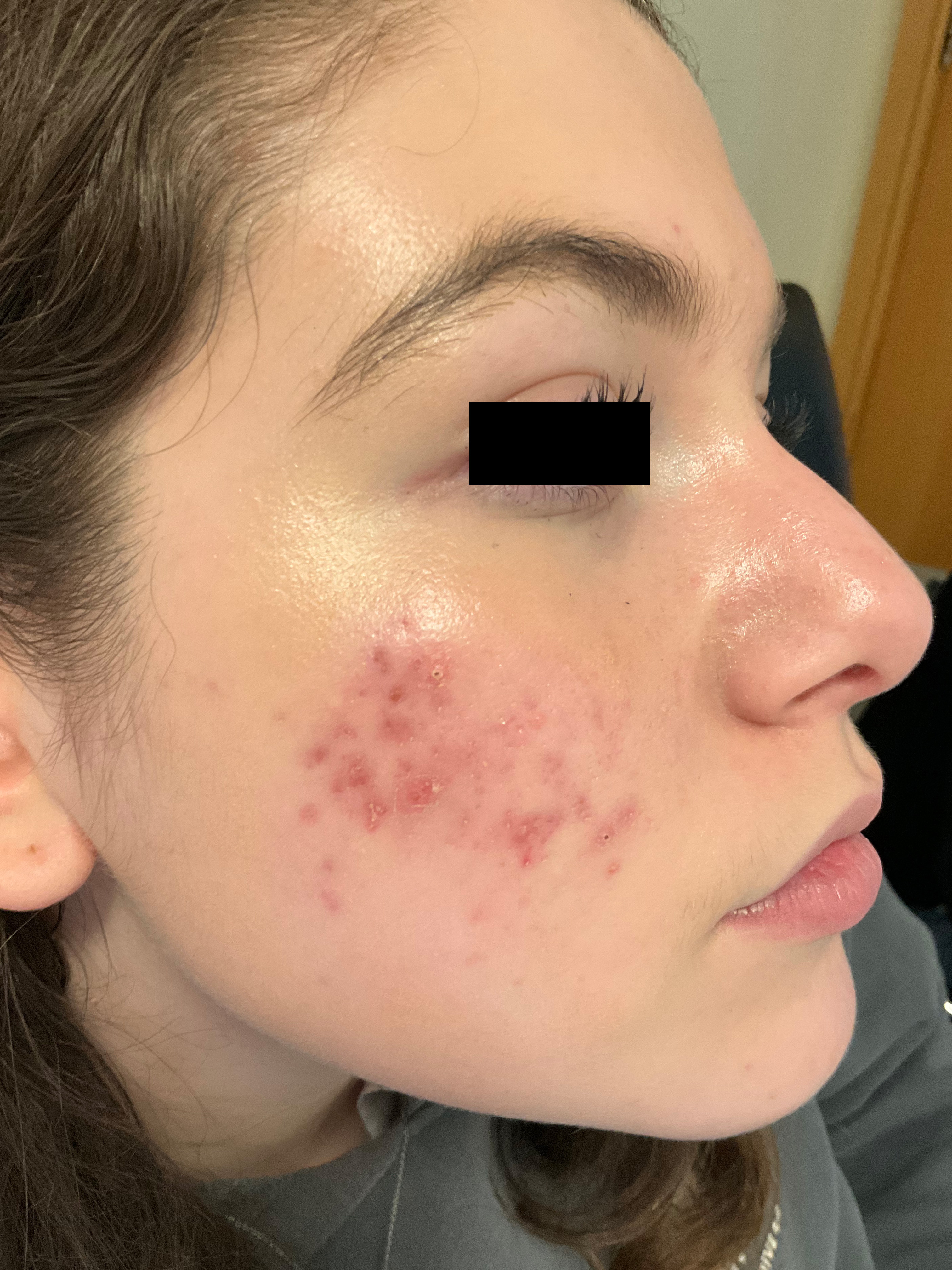 Face with severe inflammatory acne and cystic lesions prior to isotretinoin course.