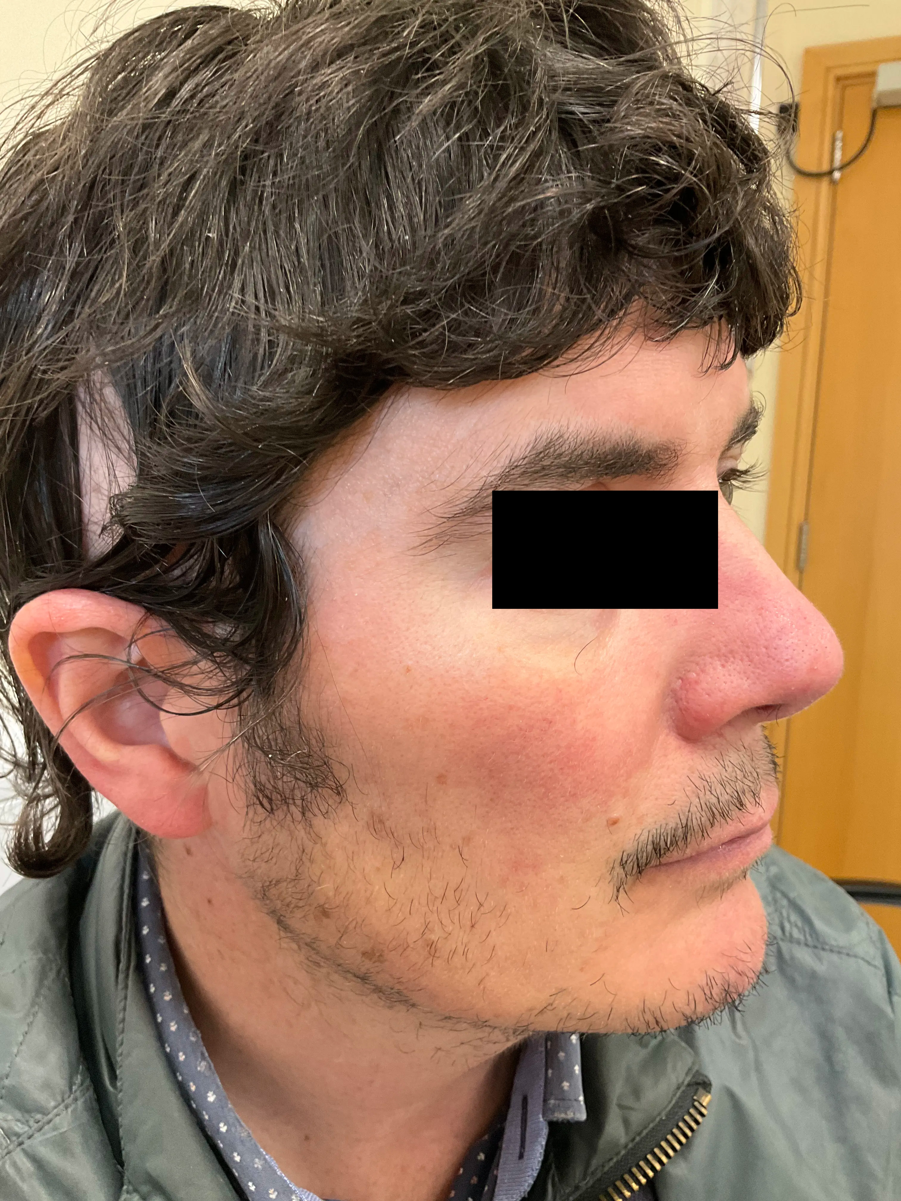 Cheeks with soothed tone and reduced erythema after rosacea care.