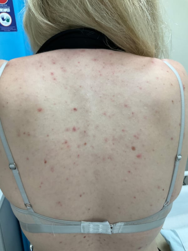 Back or chest area with widespread inflammatory acne and post-inflammatory marks before treatment.