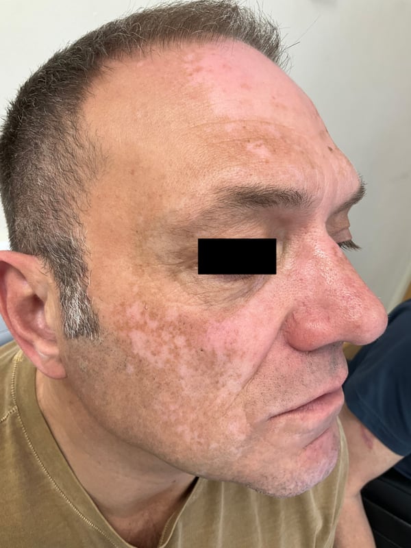 Skin area showing characteristic vitiligo depigmentation before repigmentation therapy.